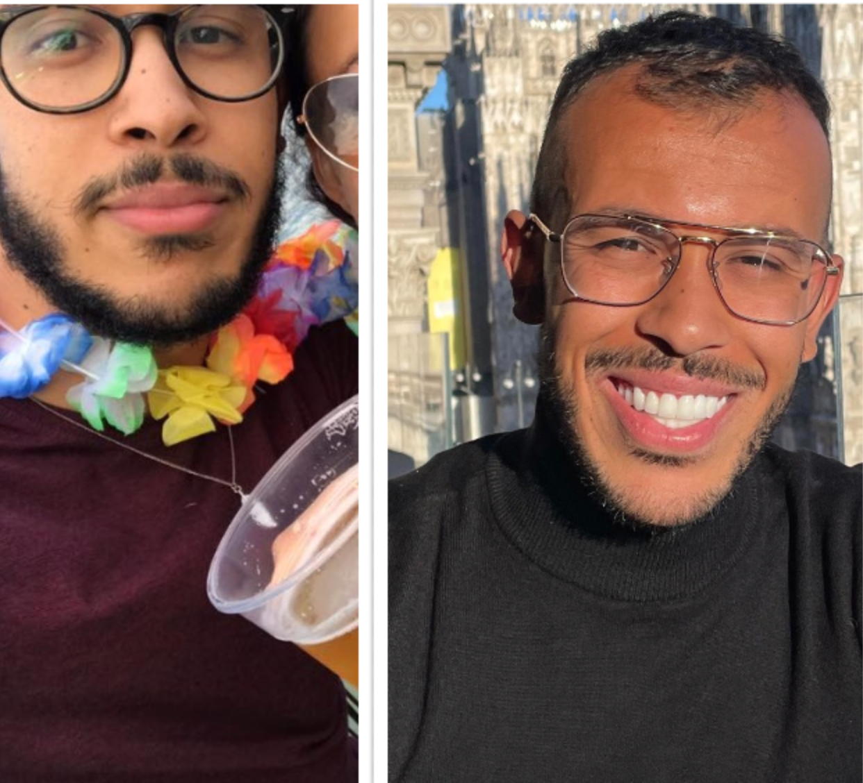 Create-online-photo-collages-PhotoCollage-com (1) Anis face before and after